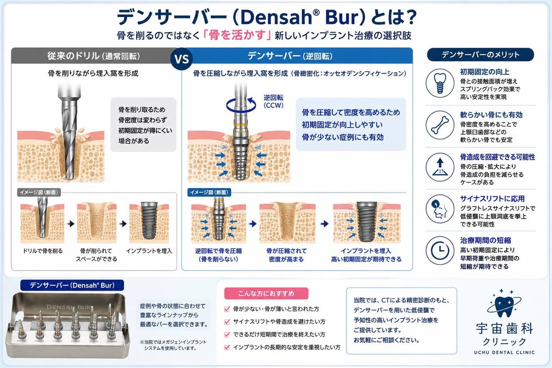 デンサーバーの解説図