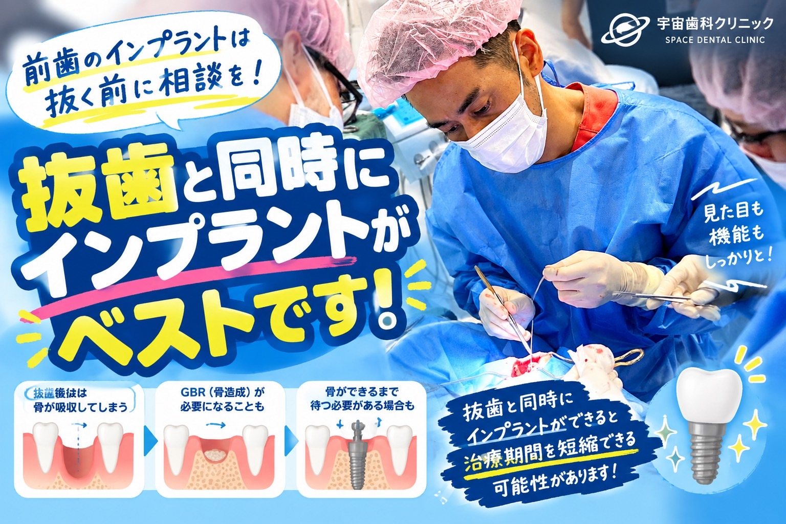 前歯の抜歯後に骨が吸収する過程と、抜歯即時埋入を解説した図