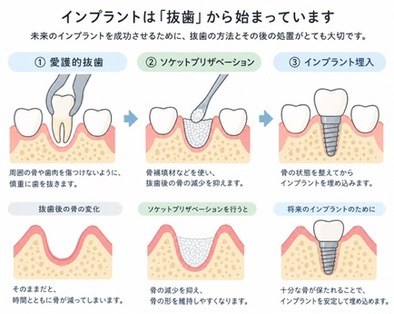 愛護的抜歯・ソケットプリザベーション・インプラント埋入の流れと、処置の有無による骨の変化を比較した図