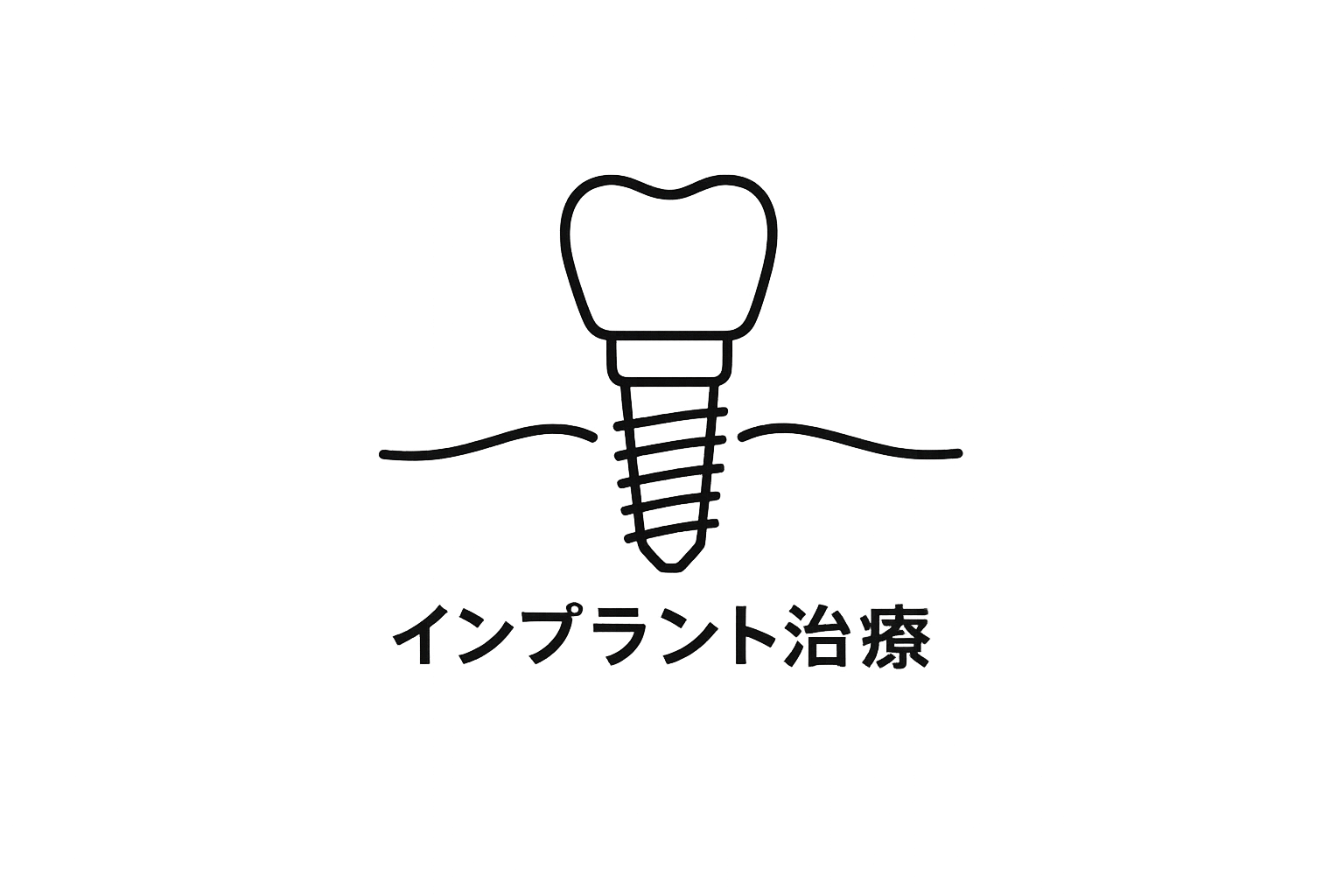 インプラント