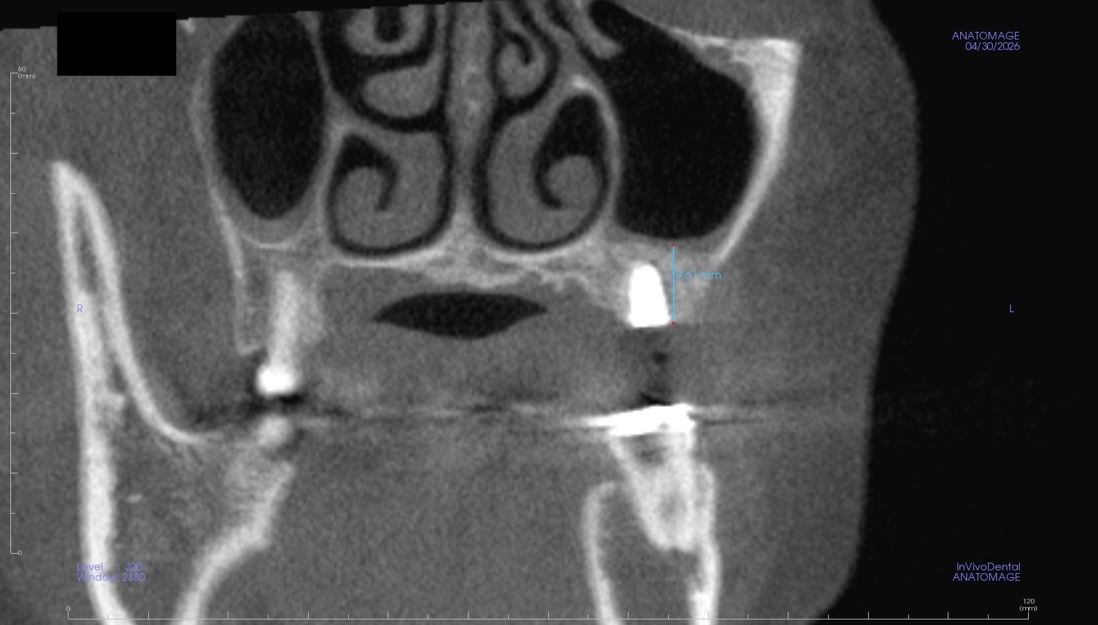症例1 サイナスリフト術後CT 冠状断